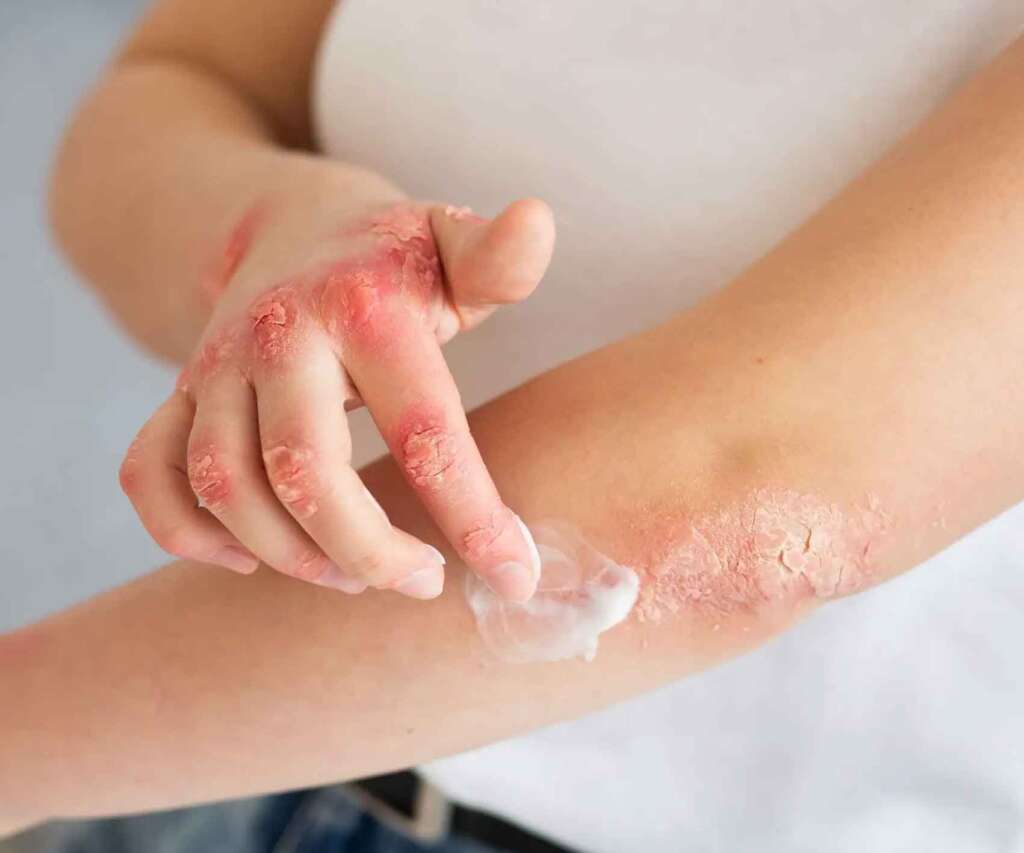 Psoriasis Ayurveda Treatment Centre In Kannur